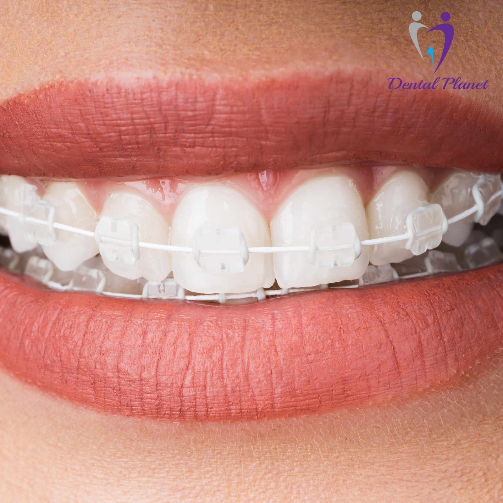 Ceramic Tooth-Colored Braces - Dental Planet